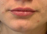 Lip Filler 12 Before